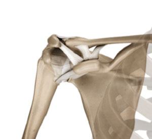 Acromioclavicular (AC) Joint Osteoarthritis