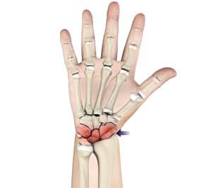  Arthritis of the Hand and Wrist 