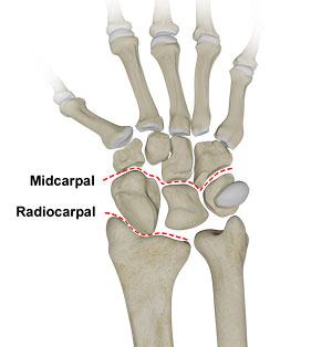  Carpal Instability 