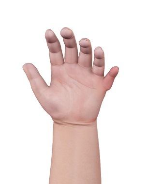  Congenital Defects of the Hand and Wrist 