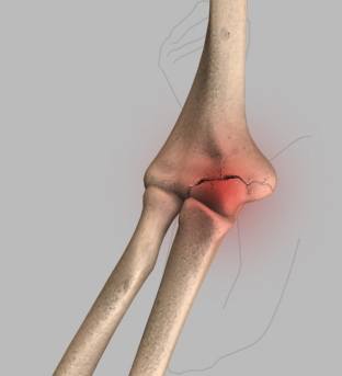 Elbow Injuries