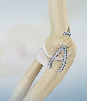  Elbow Ligament Reconstruction 