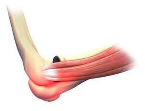  Elbow Sprain 