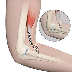  Elbow Tendon and Ligament Repair 