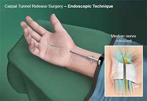  Endoscopic Cubital Tunnel Release 