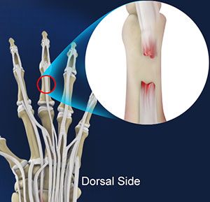  Extensor Tendon Injuries 