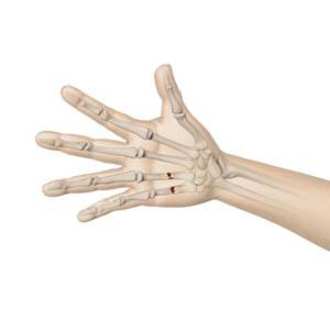  Fractures of the Hand and Fingers 