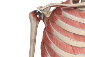  Revision Shoulder Replacement 