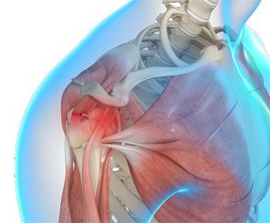 Rotator Cuff Tear