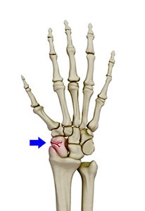 Scaphoid Fracture