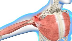  Shoulder Impingement 