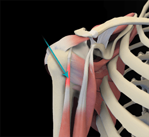  Shoulder Tendonitis 