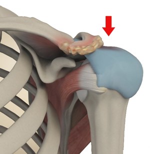  Subacromial Decompression 