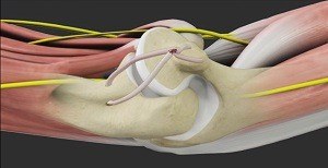  UCL Reconstruction (Tommy John Surgery) 