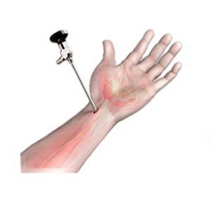  Wrist Arthroscopy 